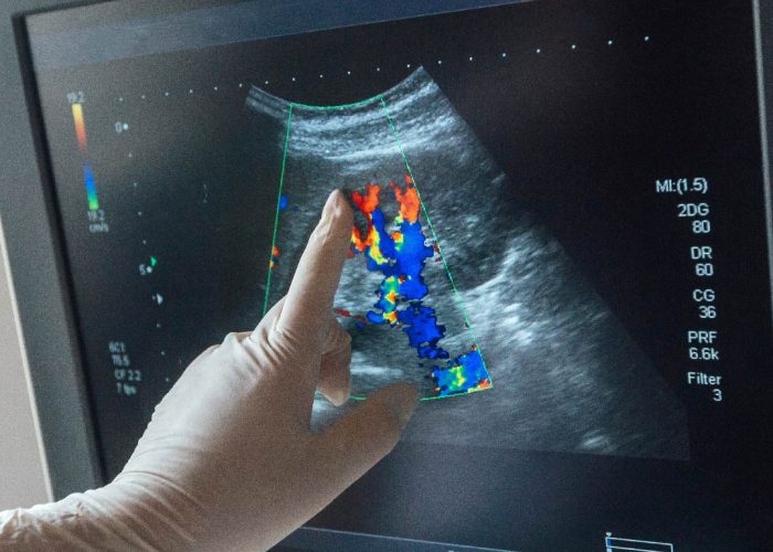 Colour-doppler.jpg