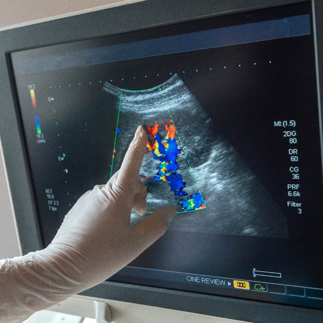 Colour-doppler.jpg